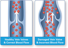 Venous Disease Explained